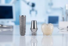 A detailed, photorealistic macro image of the three separate components of a dental implant—the titanium screw, the connecting abutment, and the final ceramic tooth crown—laid out on a clean, sterile surface in a modern dental clinic.