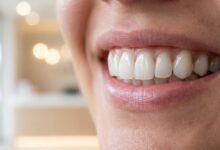 A detailed close-up of a person's perfect, bright smile, showcasing the natural and flawless appearance of well-maintained dental veneers against a soft, blurred background.