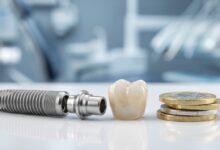 A close-up, detailed image of a dental implant's components—a titanium screw, an abutment, and a ceramic crown—placed next to a stack of British Pound coins on a clean, sterile surface.