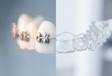 A photorealistic split image showing a close-up of a traditional metal brace on the left and a clear plastic aligner on the right, set against a clean, blurred background to represent the choice between orthodontic options.