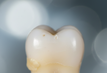An extremely close-up, detailed photograph of a human tooth with noticeable plaque buildup and slight discoloration at the gumline, set against a blurred, neutral background.