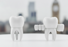 Two pristine, conceptual models representing dental solutions. On the left, a single, integrated tooth with a strong, root-like base symbolizes a dental implant. On the right, a dental bridge structure shows a replacement tooth supported by two crowned adjacent teeth. The background is a heavily blurred, out-of-focus UK cityscape, emphasizing the location context. The image is clean, professional, and free of any text.